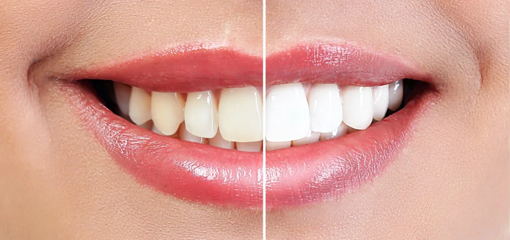 Éclaircissement dentaire professionnel réalisé par