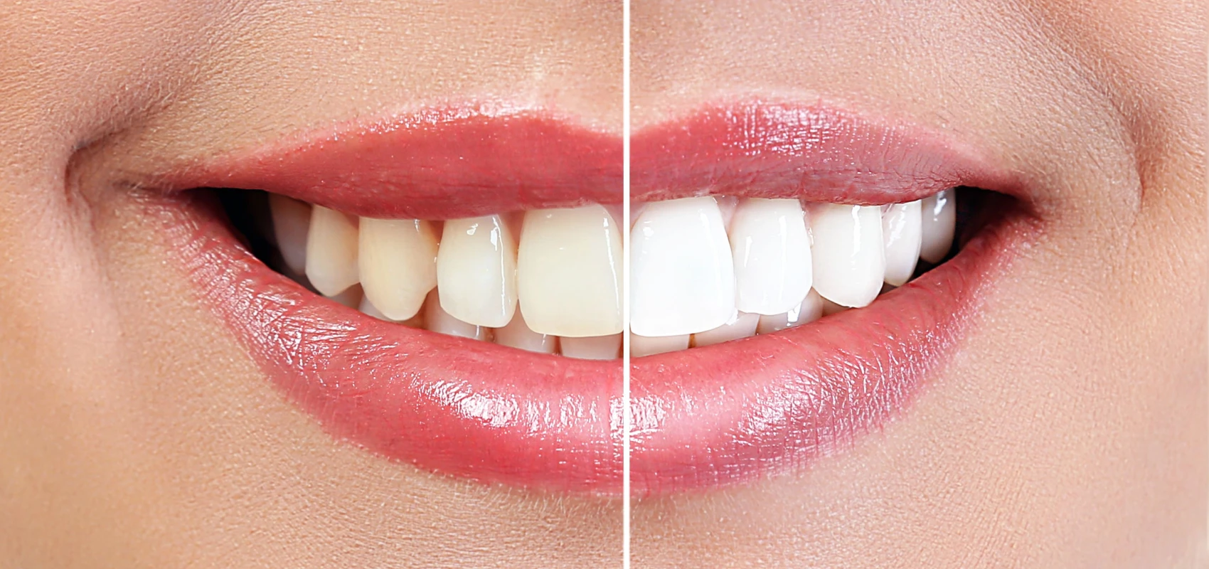 Éclaircissement dentaire professionnel réalisé par