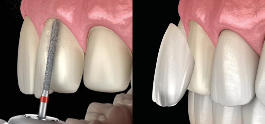 Pose de facettes dentaires