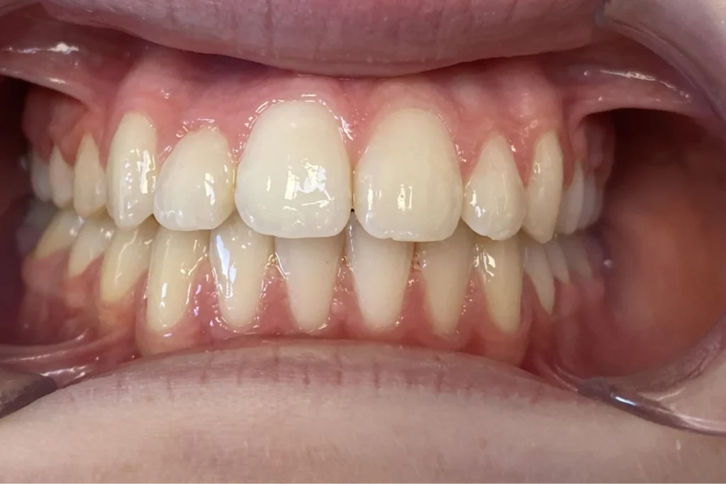 orthodontie adolescent trouillas 1 2