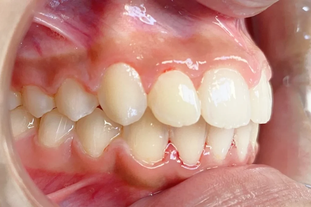 orthodontie adolescent trouillas 4 4