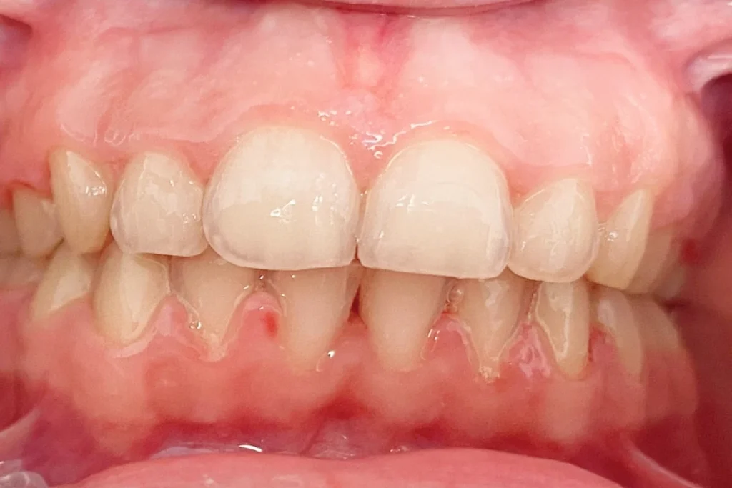 orthodontie adolescents 3 2