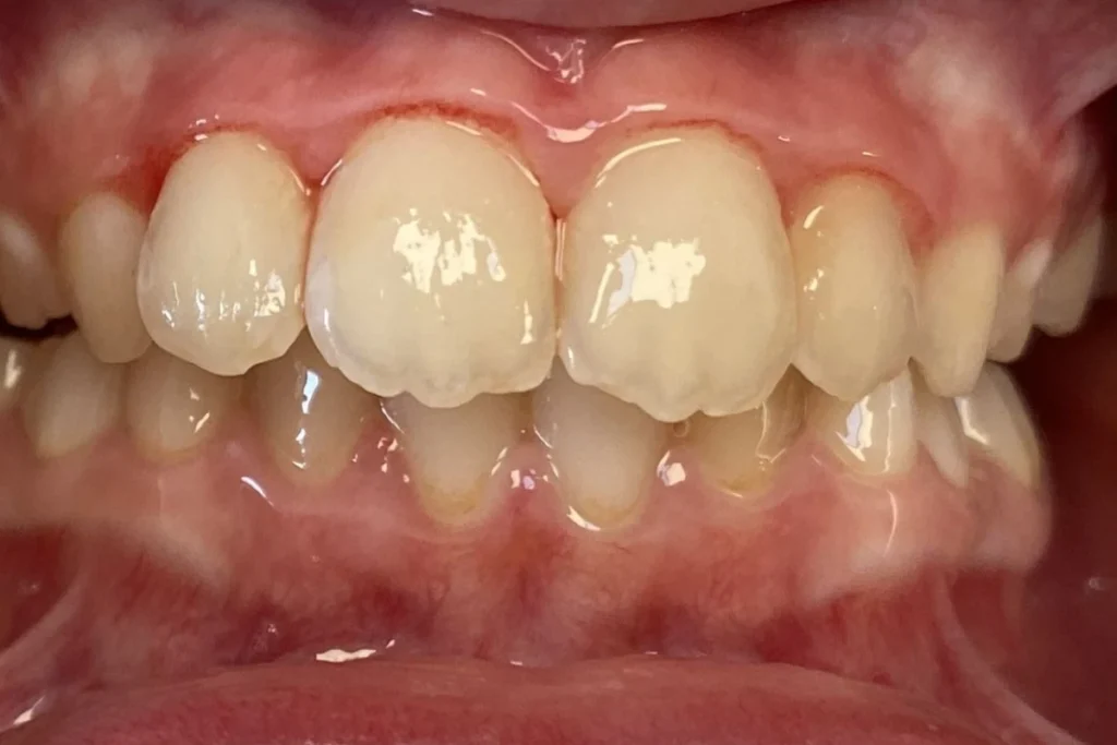 orthodontie enfant trouillas 1 2