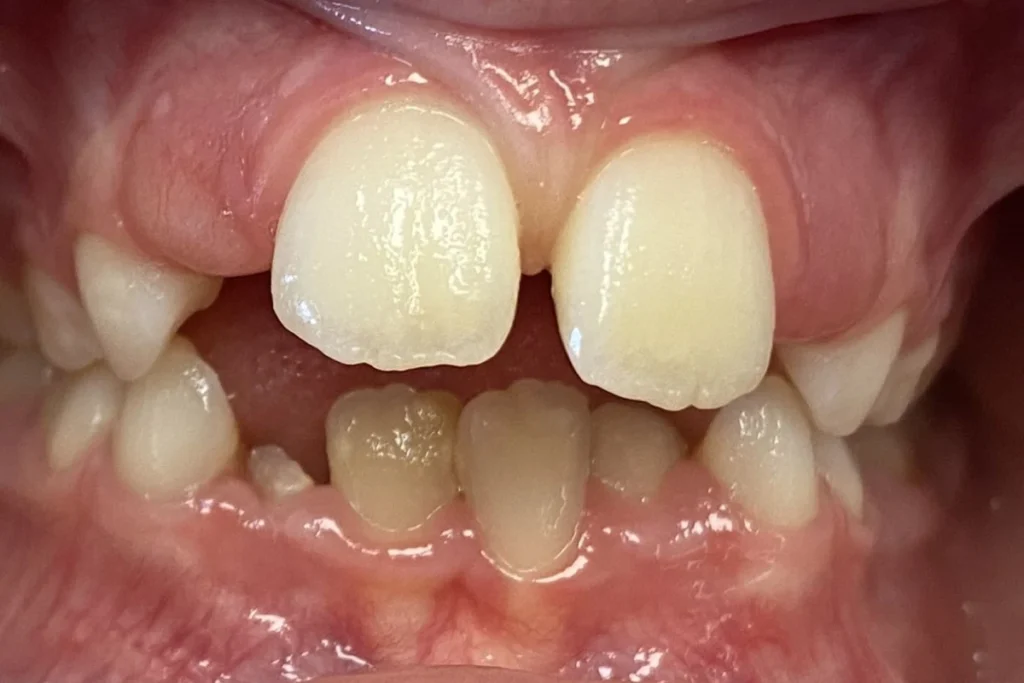 orthodontie enfant trouillas 2 1