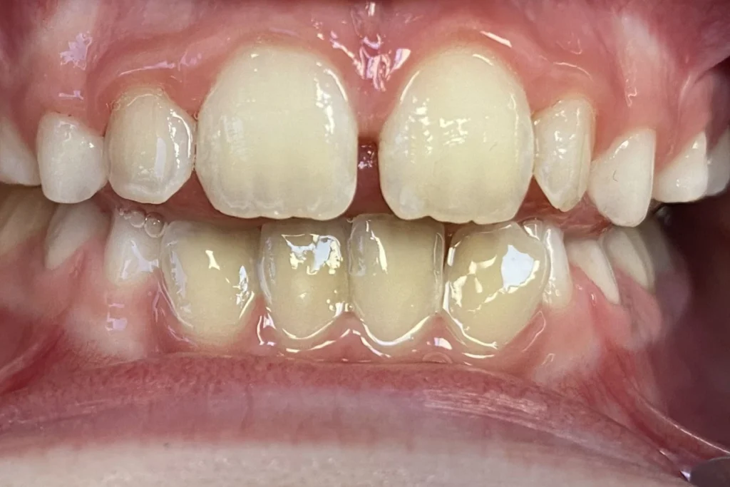 orthodontie enfant trouillas 3 2